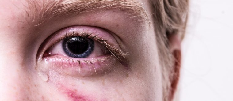 פציעה במהלך החופשה: מה לעשות כשהטיול משתבש?